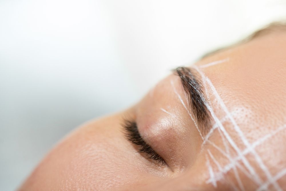 Close-up of a person's eye and eyebrow with white lines drawn on their skin, likely for a cosmetic procedure.