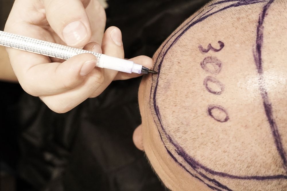 Person's scalp marked with purple lines and the number 3000, preparing for a hair transplant.