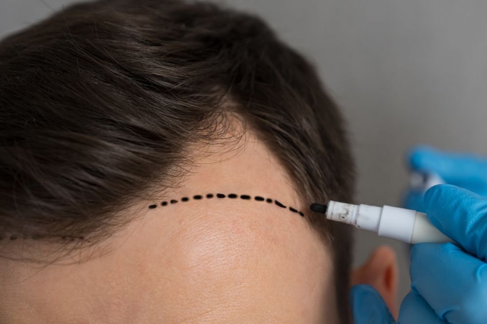 Man's hairline marked with dotted line for hair transplant procedure. Hand in blue glove holds a marker.