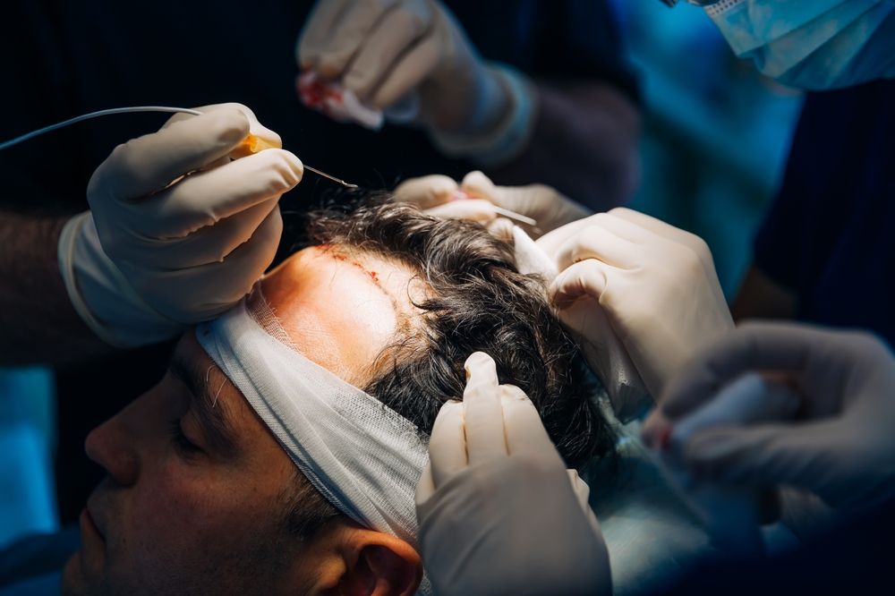 Hair transplant surgery in progress; scalp with inserted hair follicles, gloved hands, medical setting.