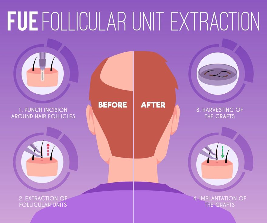 An infographic showing the four steps of Follicular Unit Extraction (FUE) hair transplant on a split-screen background.