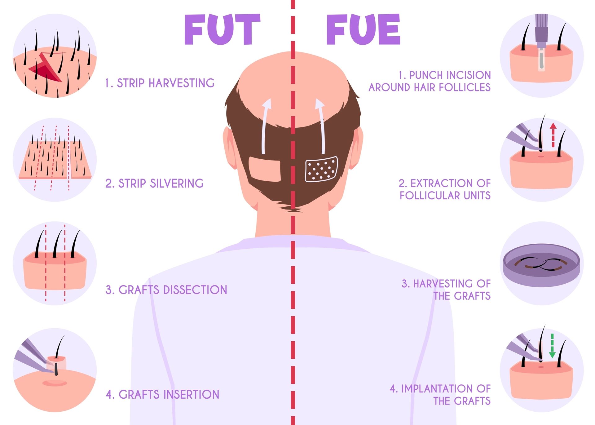 Diagram comparing FUT and FUE hair transplant methods. Displays steps for each: harvesting