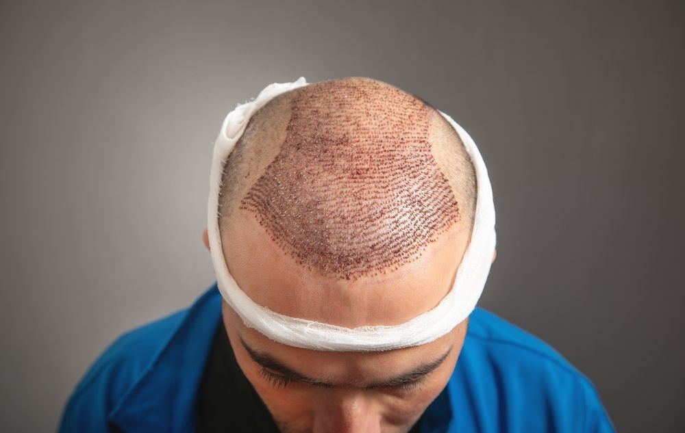 Man with shaved head and bandaged hairline post-hair transplant surgery; visible dotted grafts.