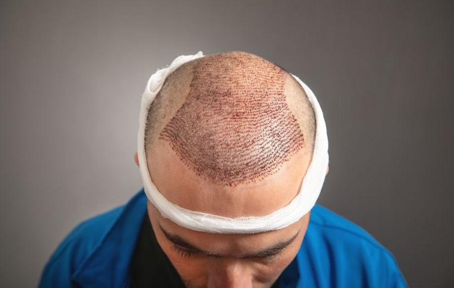 Top-down view of a person wearing a head bandage with visible red pinpricks on the scalp following a hair transplant.