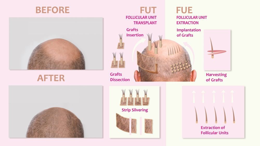 Hair transplant procedure comparison: Before/after view, FUT (strip removal), and FUE (individual graft extraction).