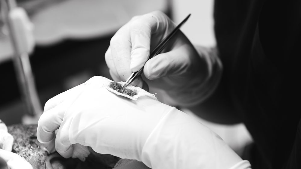 Hands in gloves using a brush to apply a dark substance to a wound.
