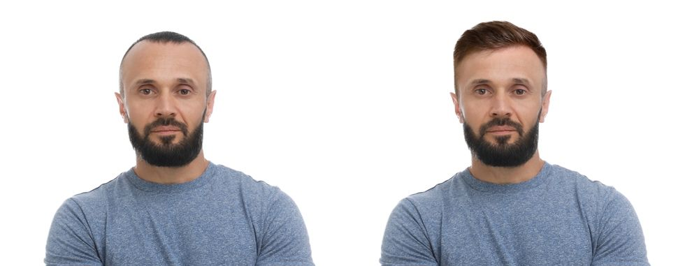 A side-by-side comparison of a person with a shaved head and the same person with a full head of hair.