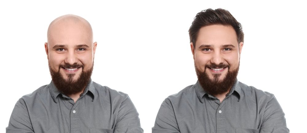 Man with a bald head next to the same man with hair. Both smiling with beards, wearing gray shirts.