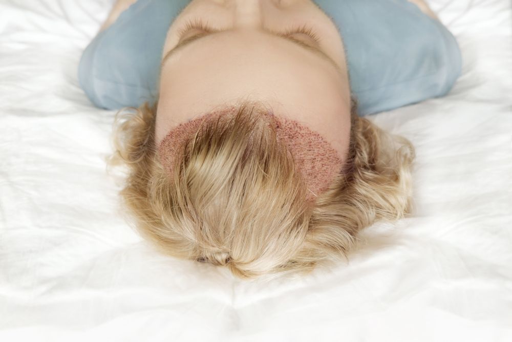 Person lying down, visible scalp with recent hair transplant, blonde hair, white bedding.