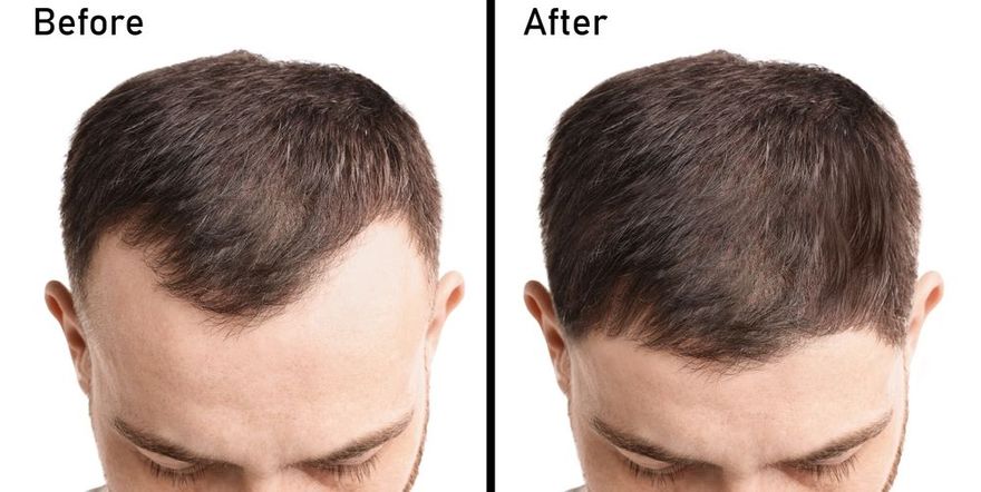 Before and after comparison showing a lower, fuller hairline after hair restoration treatment.