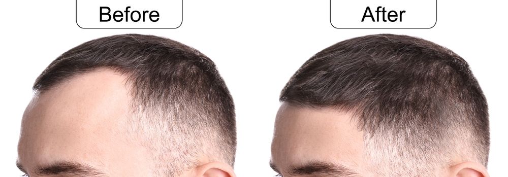Comparison of a man's hair before and after a hair treatment, showing hair loss reduction.