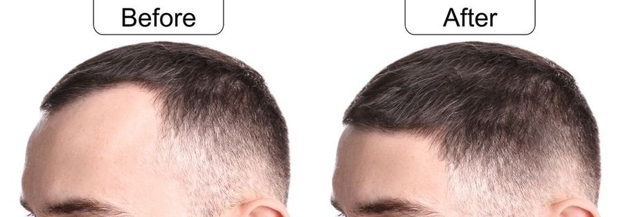 Comparison of a person’s hairline before and after a treatment, showing fuller, thicker hair in the after image.
