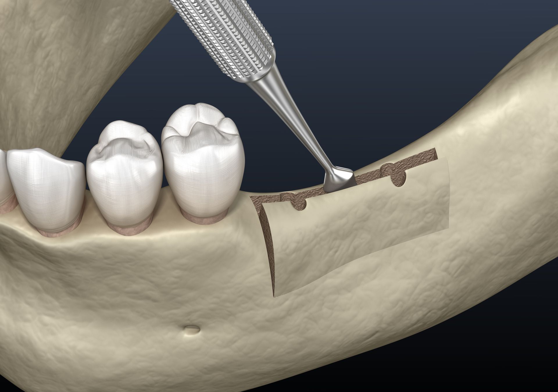 IMPLANTOLOGIA RIGENERATIVA