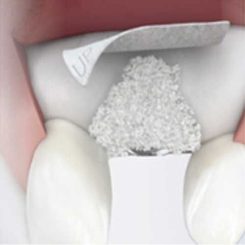 Incrementi ossei minori