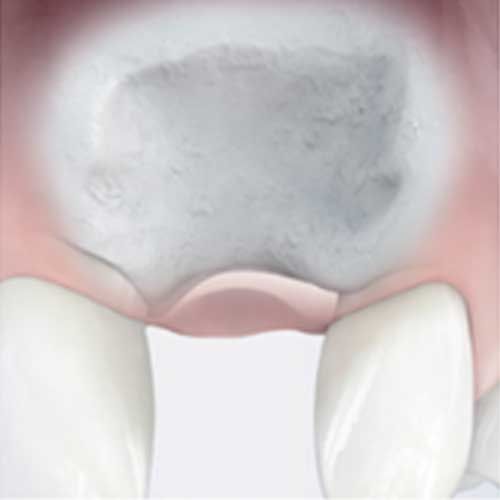 Incrementi ossei estesi