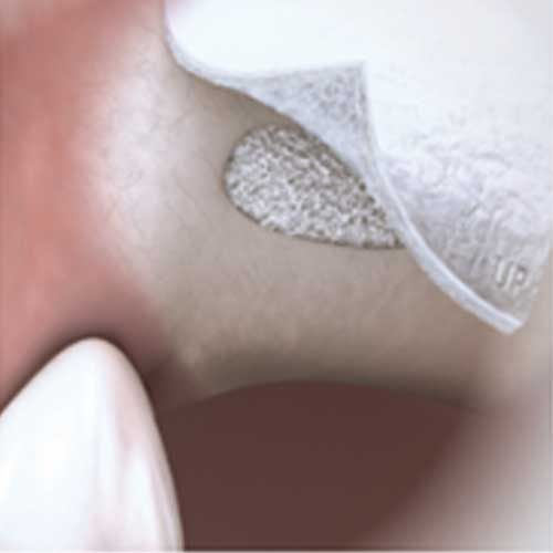 Rialzo del pavimento del seno