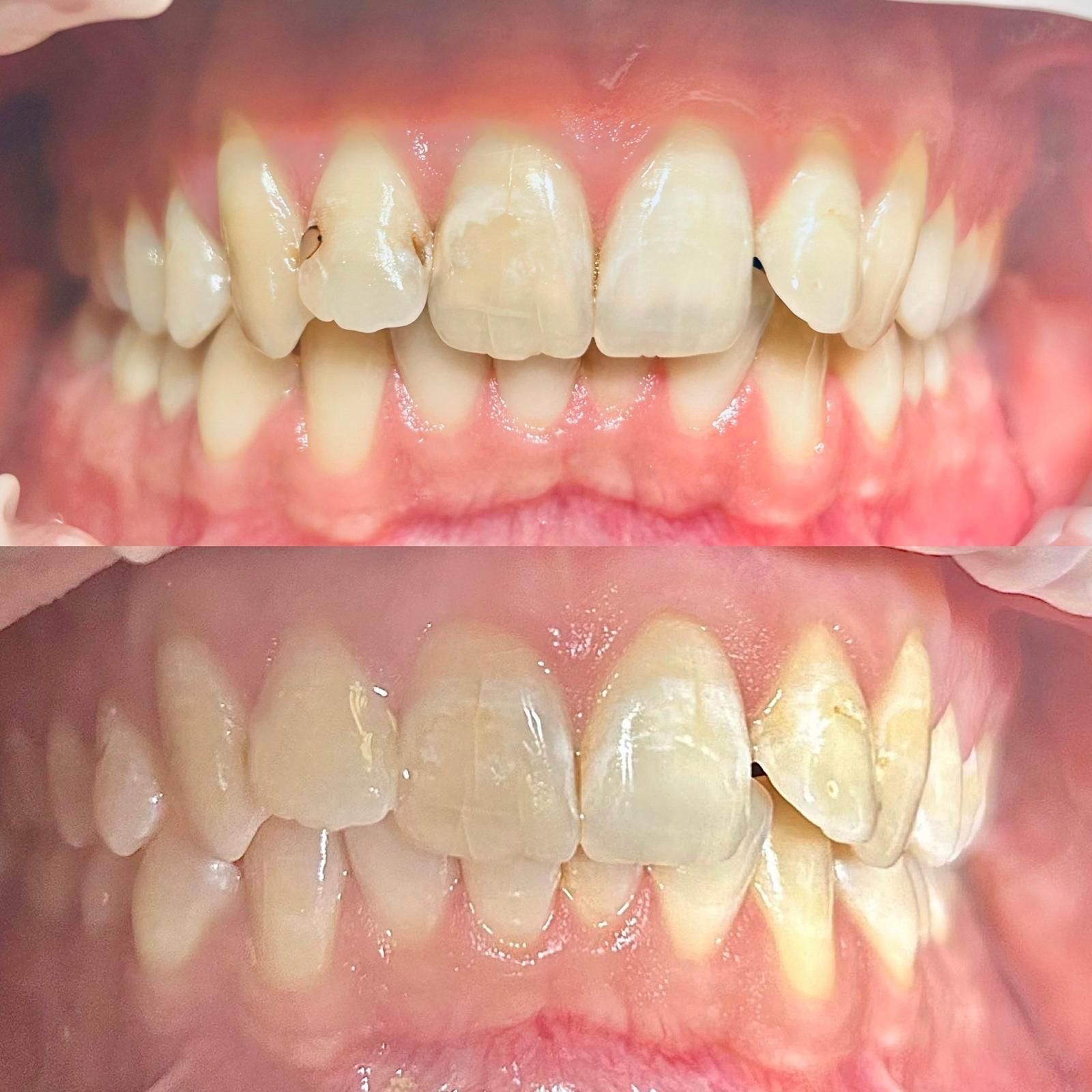 Ricostruzioni estetiche: per riparare denti scheggiati o usurati