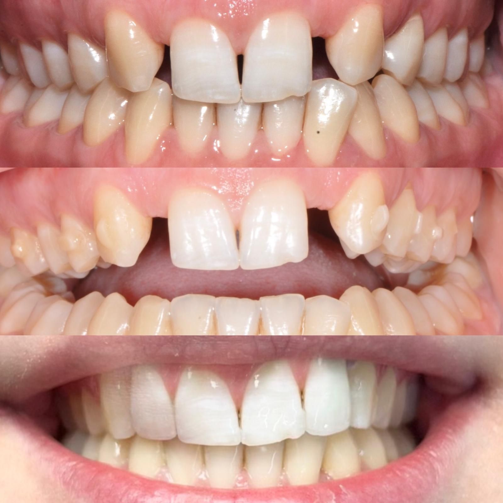 Rimodellamento gengivale: per correggere asimmetrie o gengive troppo visibili, bilanciando il rapporto tra denti e tessuti molli.