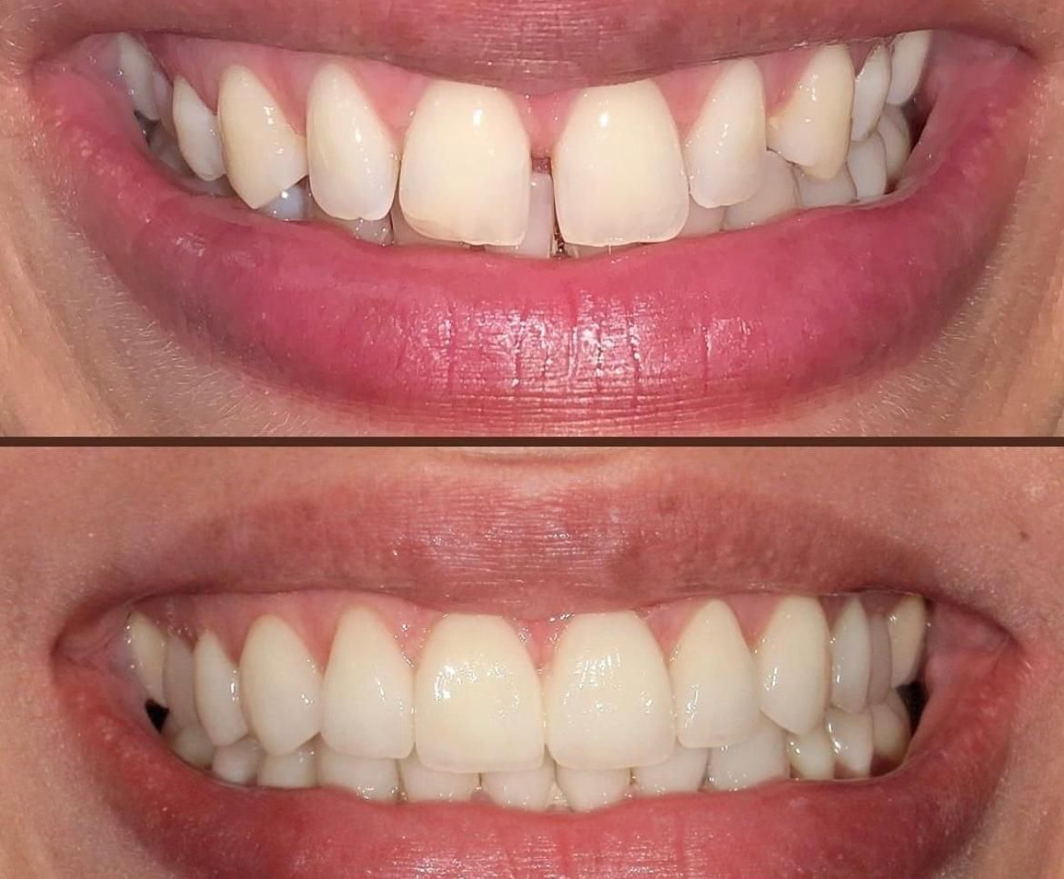 Rimodellamento gengivale: per correggere asimmetrie o gengive troppo visibili, bilanciando il rapporto tra denti e tessuti molli.