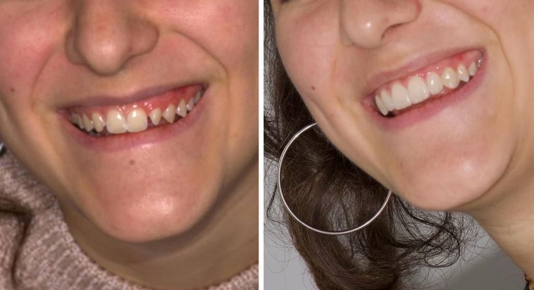 Faccette dentali in ceramica o composito: sottili rivestimenti che correggono forma, colore e posizione dei denti, donando un sorriso perfetto.