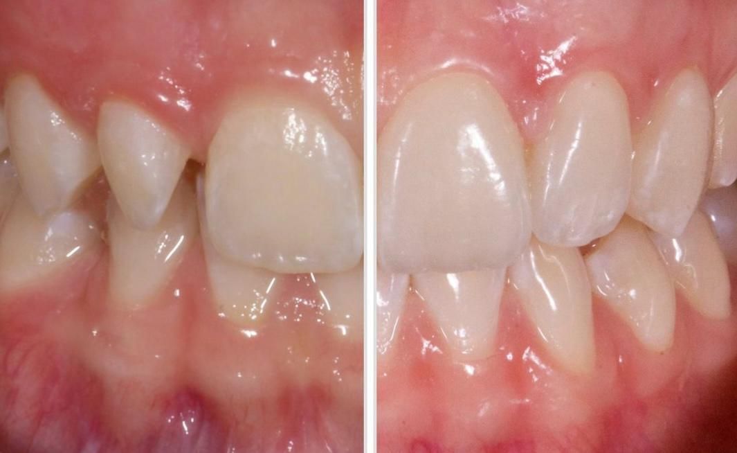 Faccette dentali in ceramica o composito: sottili rivestimenti che correggono forma, colore e posizione dei denti, donando un sorriso perfetto.