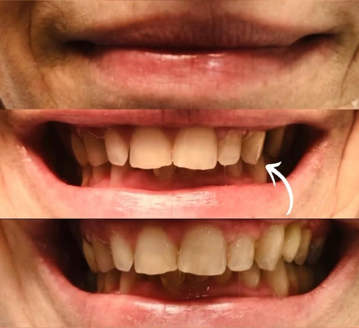 Faccette dentali in ceramica o composito