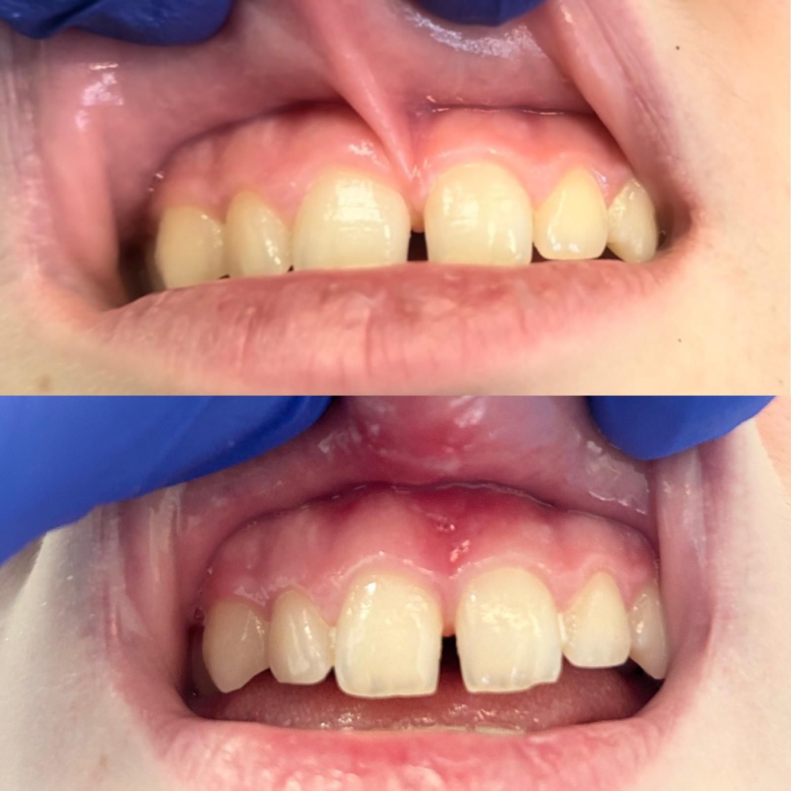 Rimodellamento gengivale: per correggere asimmetrie o gengive troppo visibili, bilanciando il rapporto tra denti e tessuti molli.