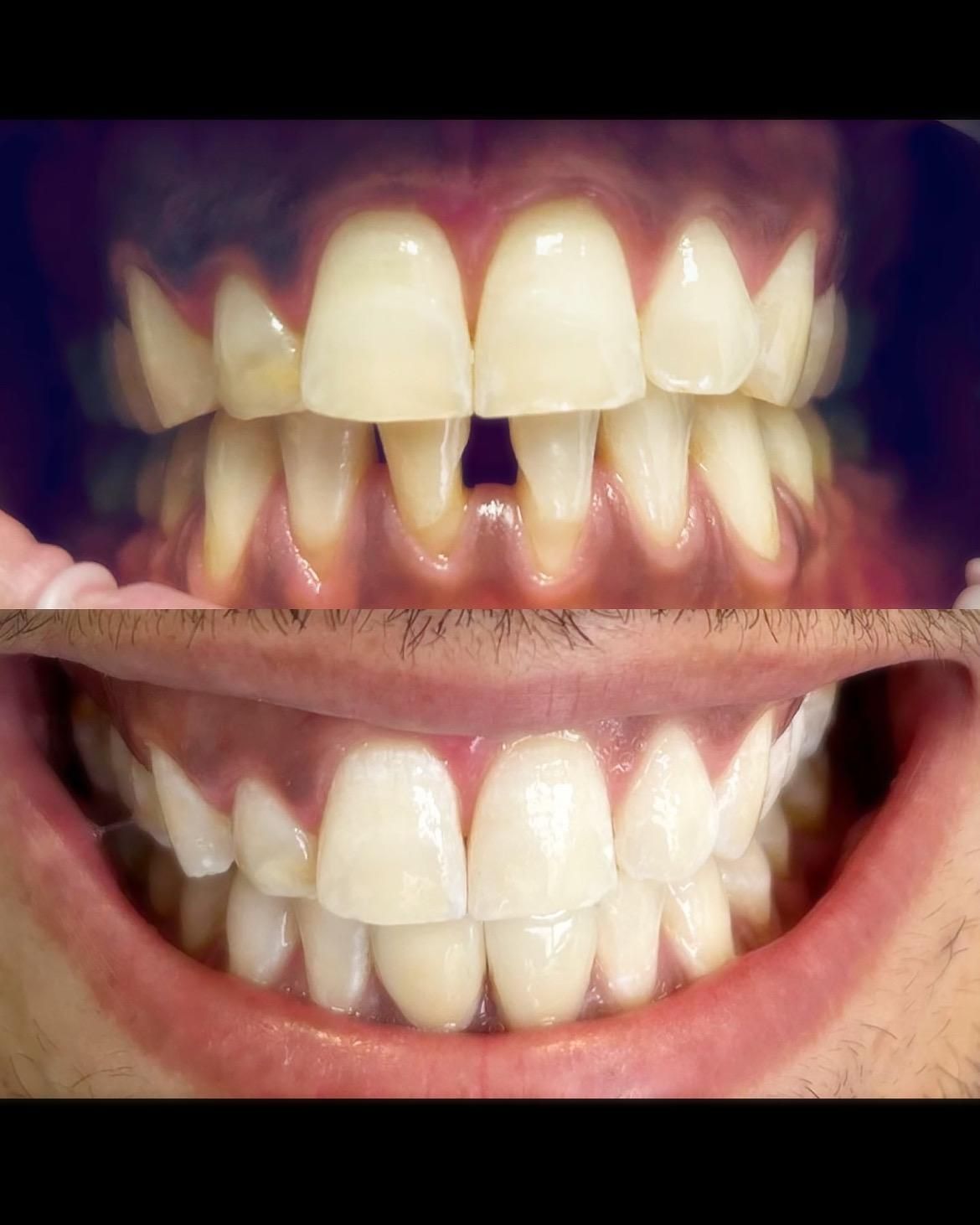 Rimodellamento gengivale: per correggere asimmetrie o gengive troppo visibili, bilanciando il rapporto tra denti e tessuti molli.