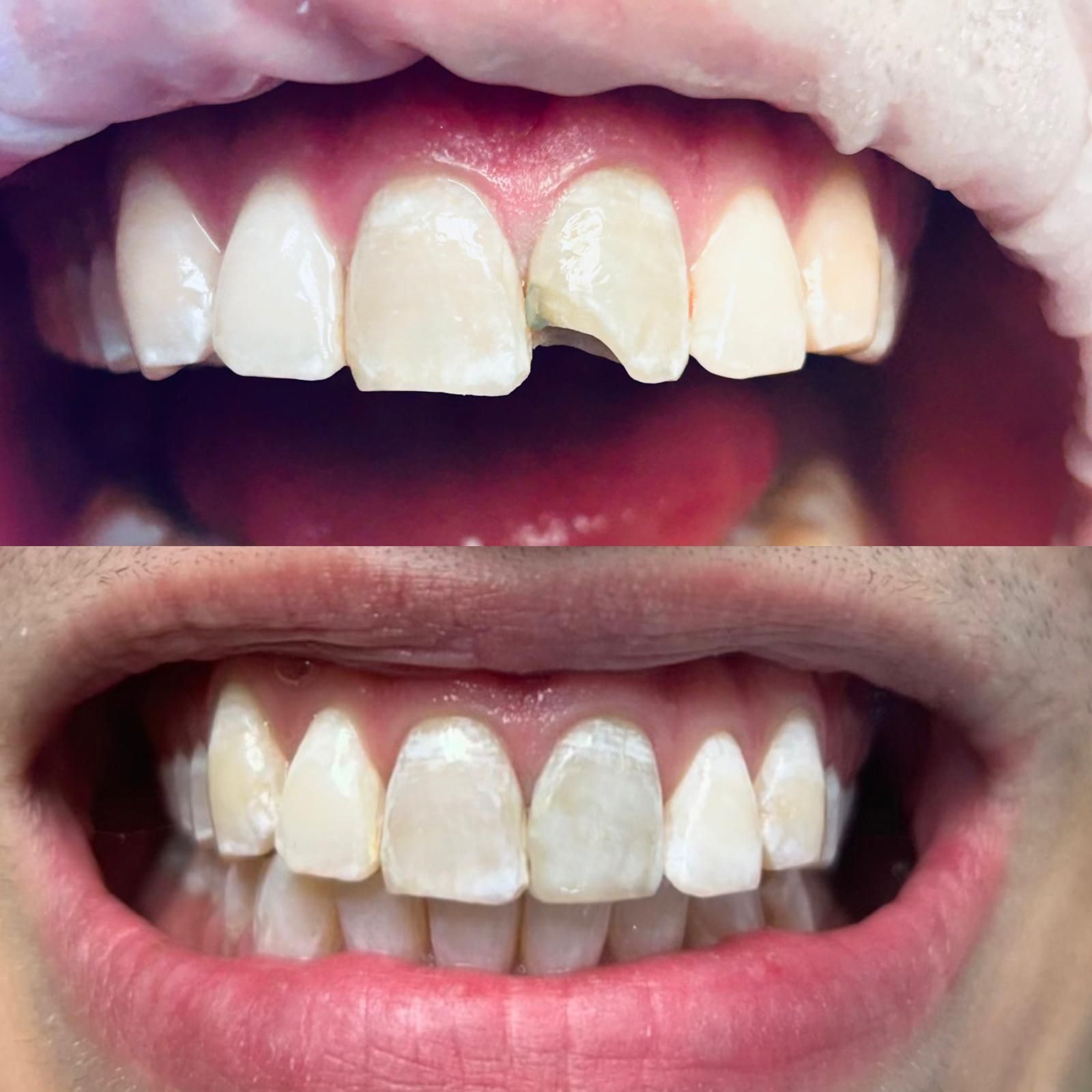 Ricostruzioni estetiche: per riparare denti scheggiati o usurati