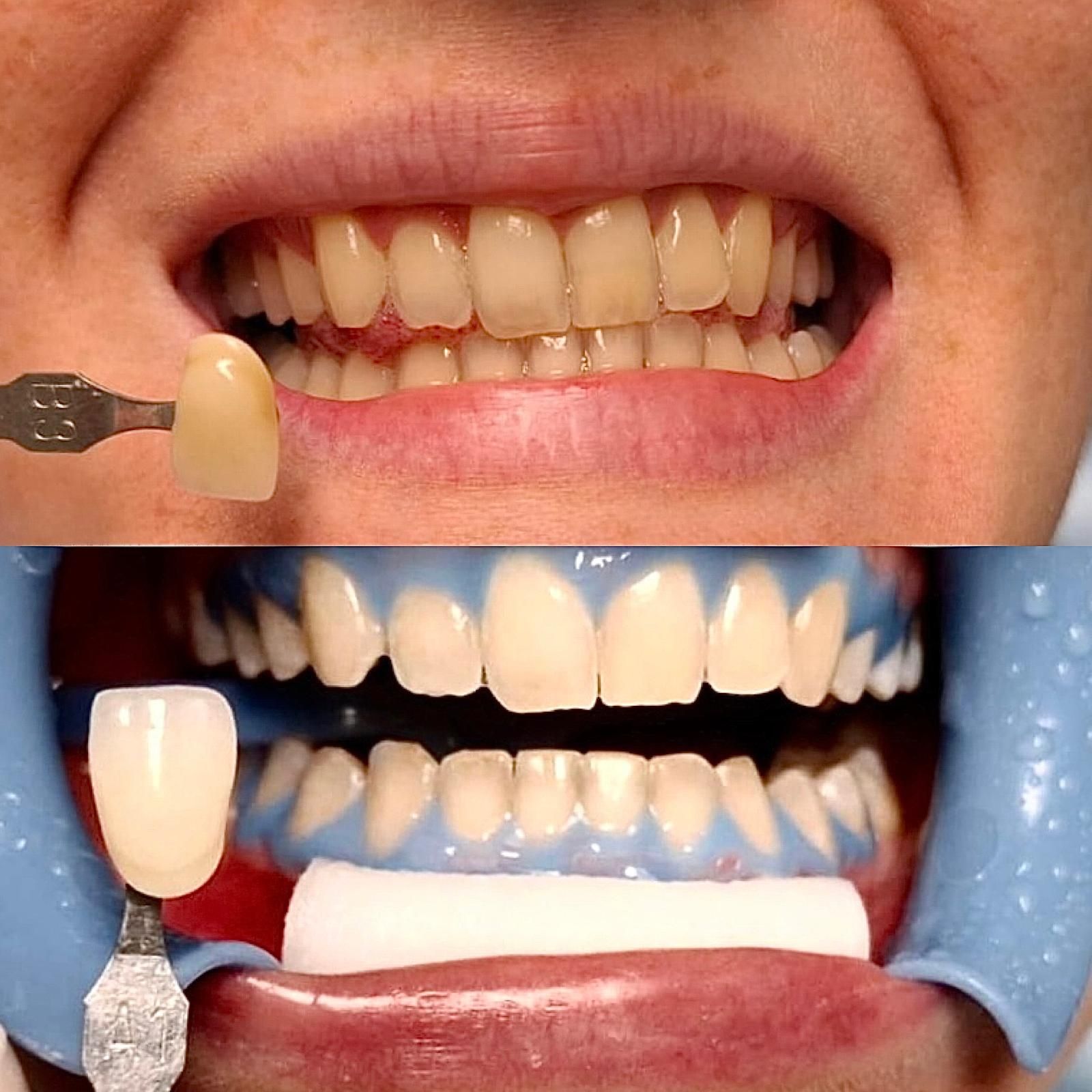 Sbiancamento dentale professionale: per rendere i denti più bianchi e luminosi, in modo sicuro e controllato.