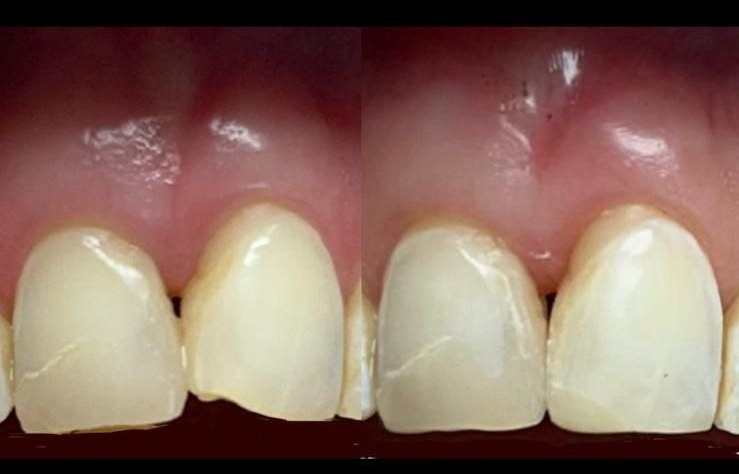 Ricostruzioni estetiche: per riparare denti scheggiati o usurati, restituendo uniformità e armonia.