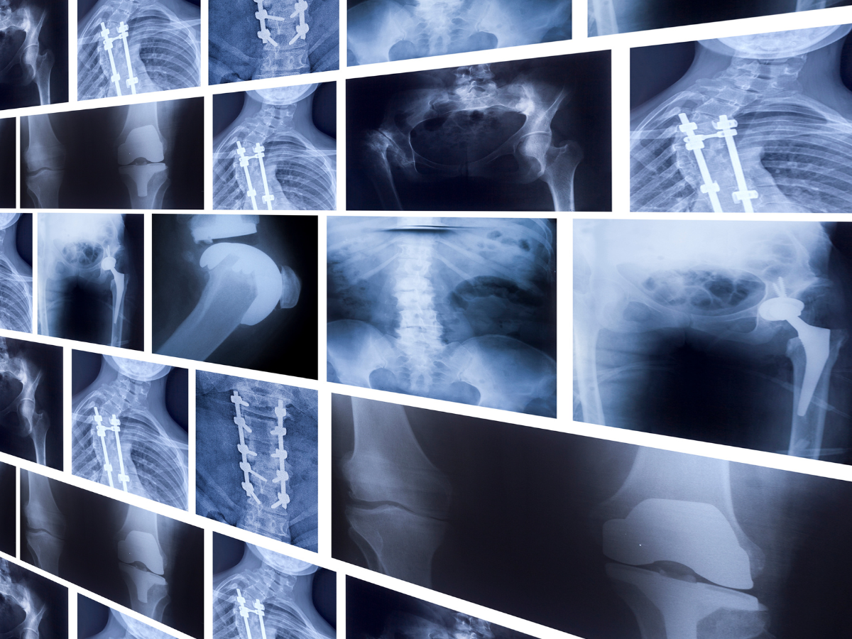 A collage of various X-ray images showcasing orthopedic implants, bone fixations, and skeletal structures in blue tones.