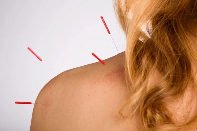 A shoulder receiving acupuncture treatment with several thin needles inserted into the skin.