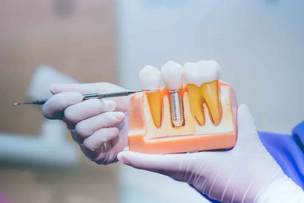 A dentist is holding a model of a dental implant in his hand.
