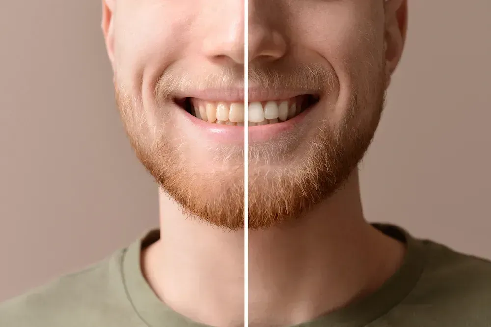 A man with a beard is smiling before and after whitening his teeth.