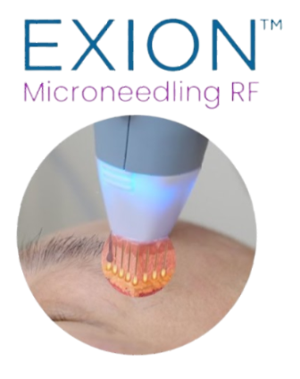 A picture of an exion microneedling rf device