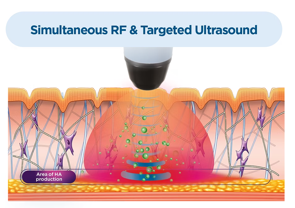 A diagram of a simultaneous rf and targeted ultrasound.