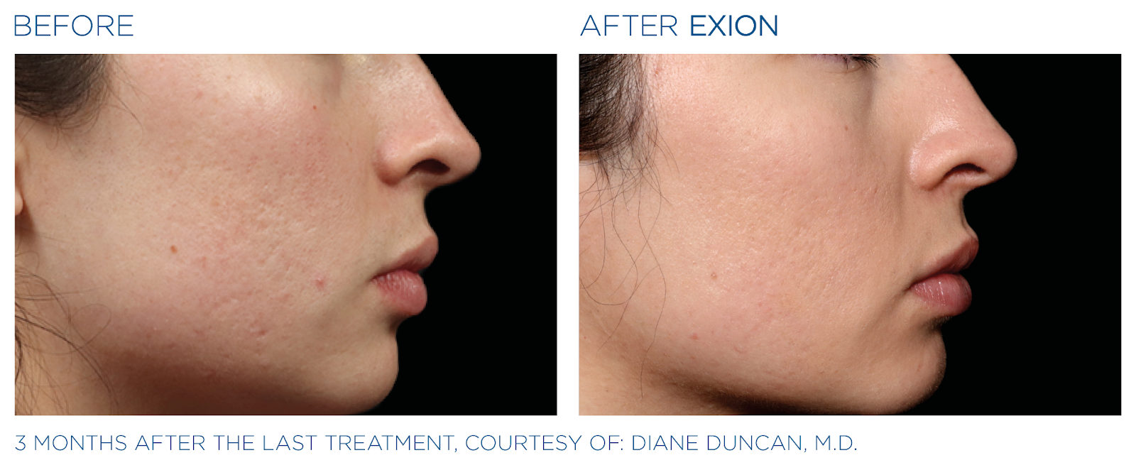 A before and after photo of a woman 's face.