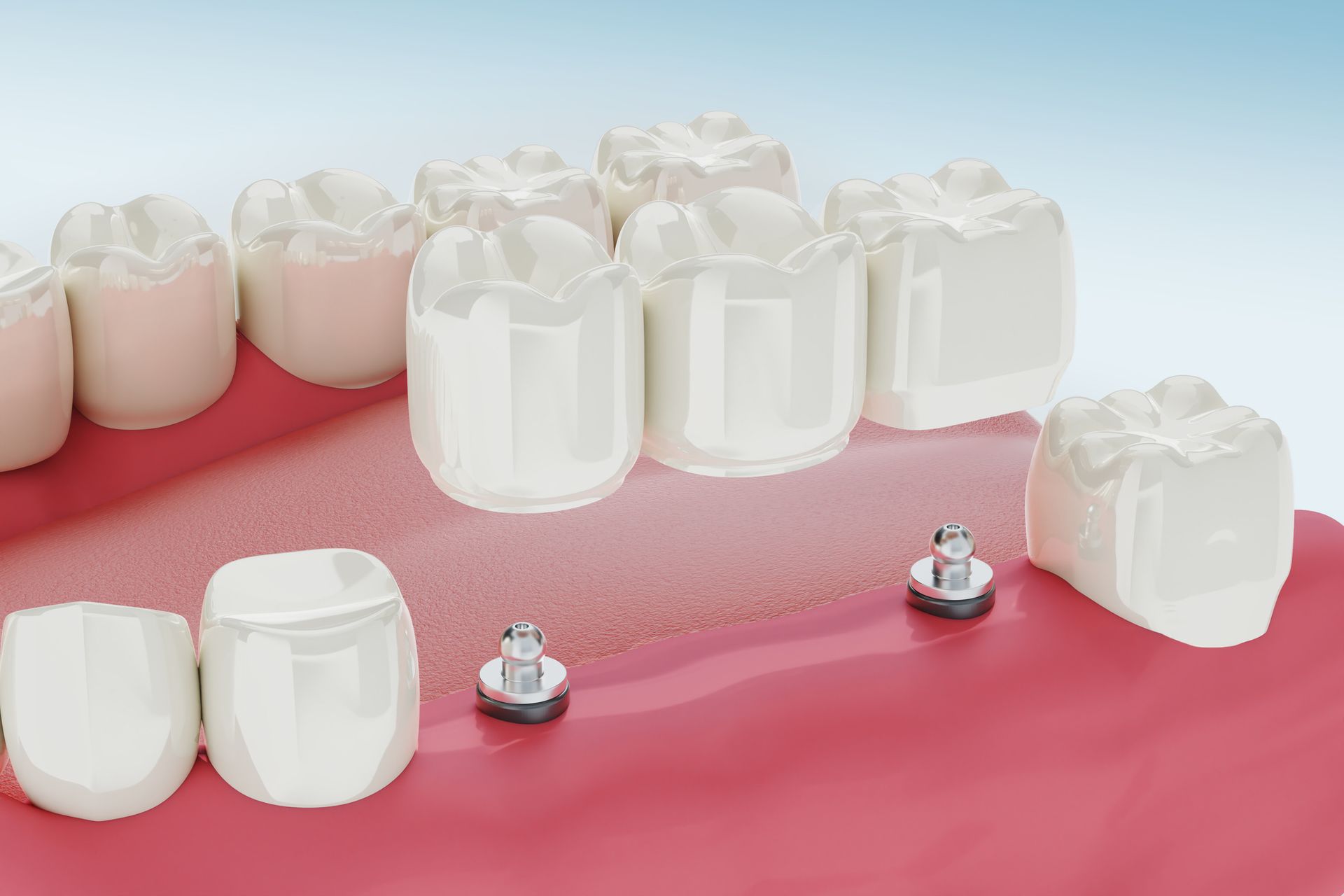 Dental implant procedure illustration; shows artificial teeth attached to embedded implants within the gums.