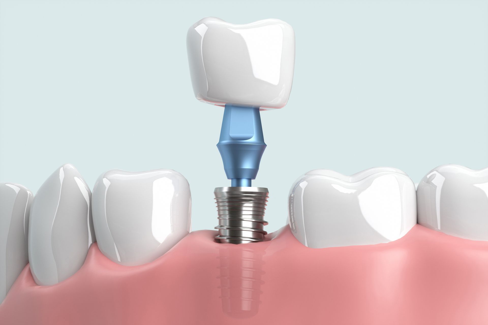 Dental implant: A tooth crown atop a blue post, screwed into the jaw, replacing a missing tooth.