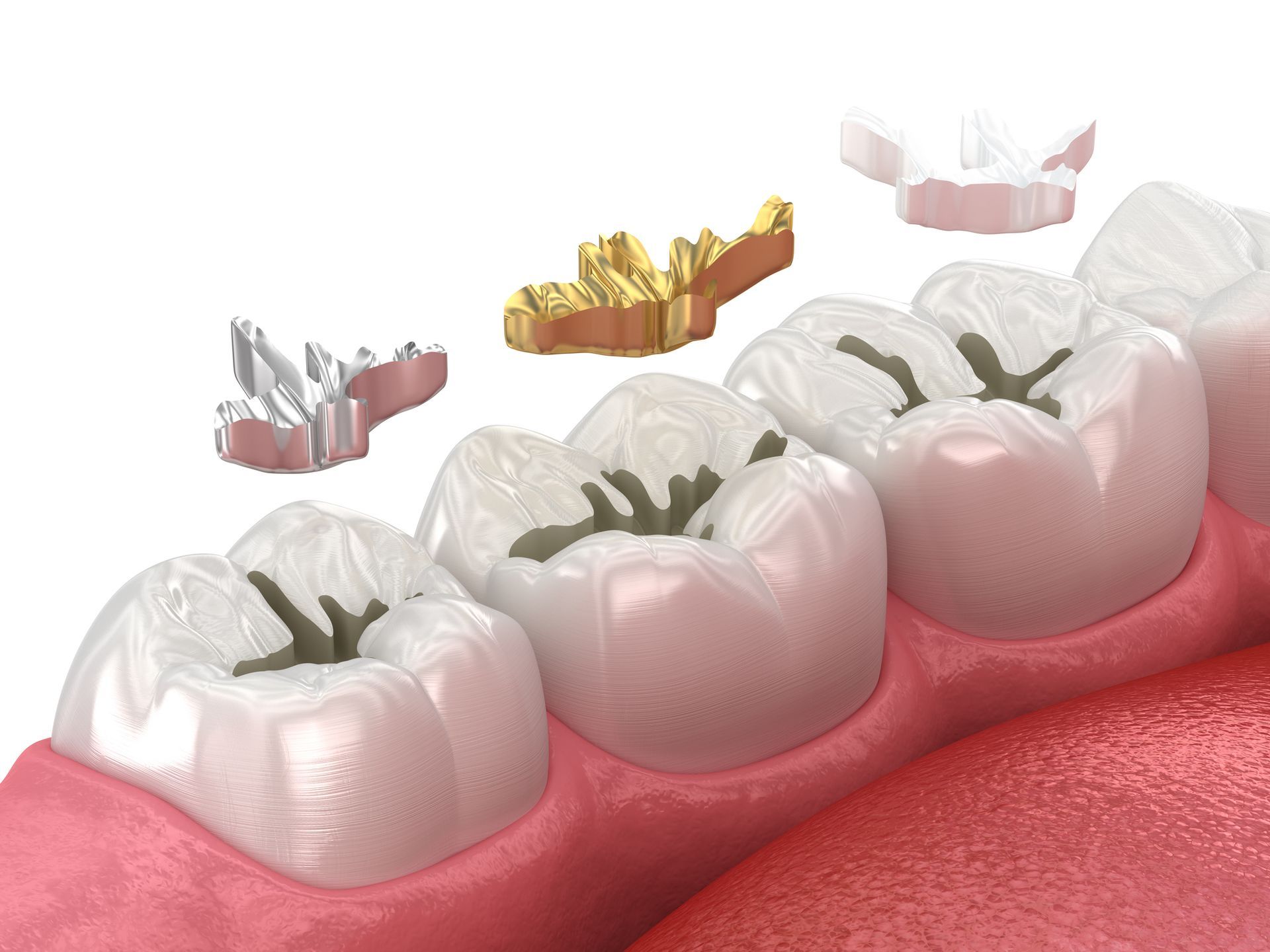 Teeth with cavities and fillings: metal, gold, and white composite replacements. Dental illustration.