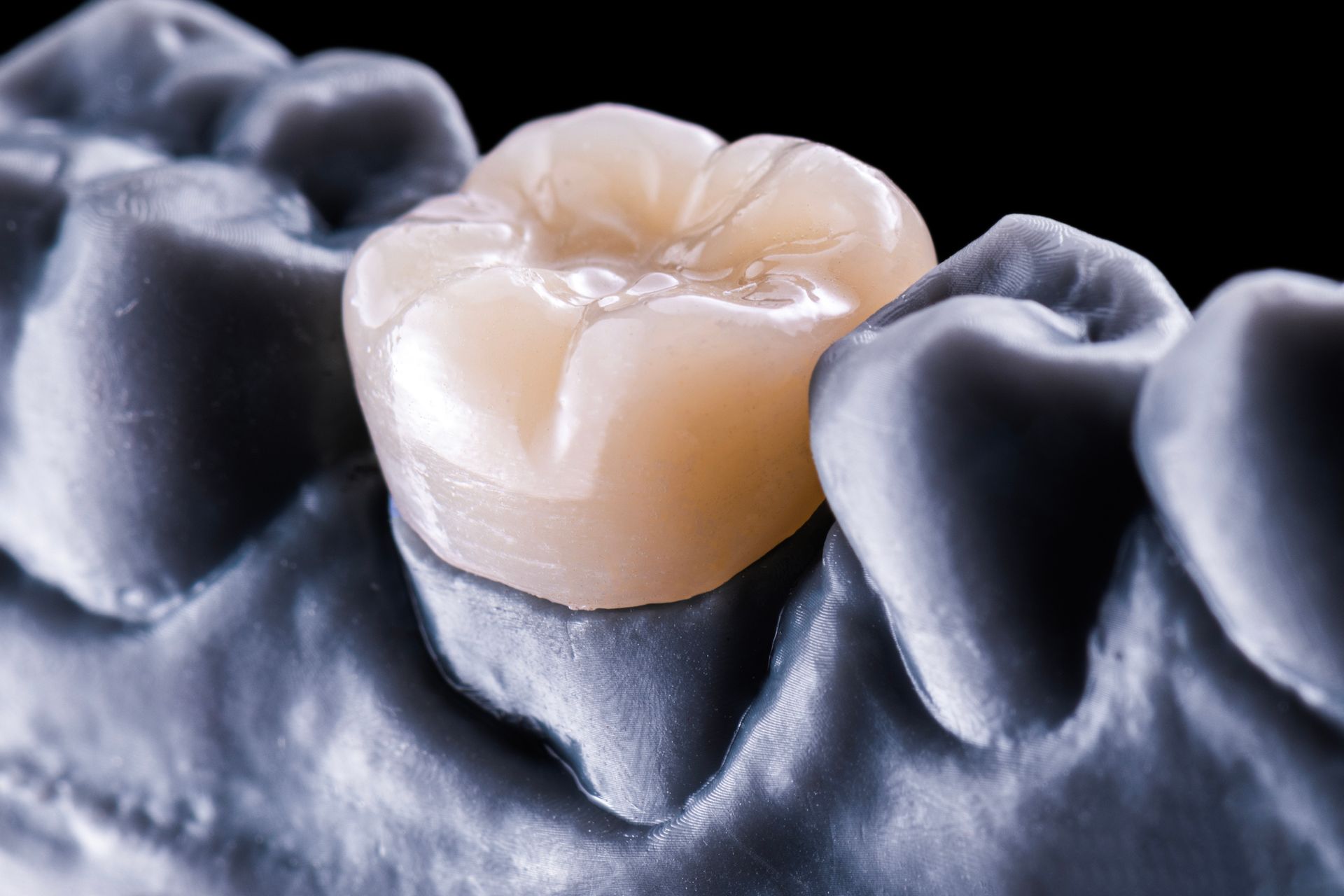 Dental crown on a gray model of teeth, light tan and cream colors.