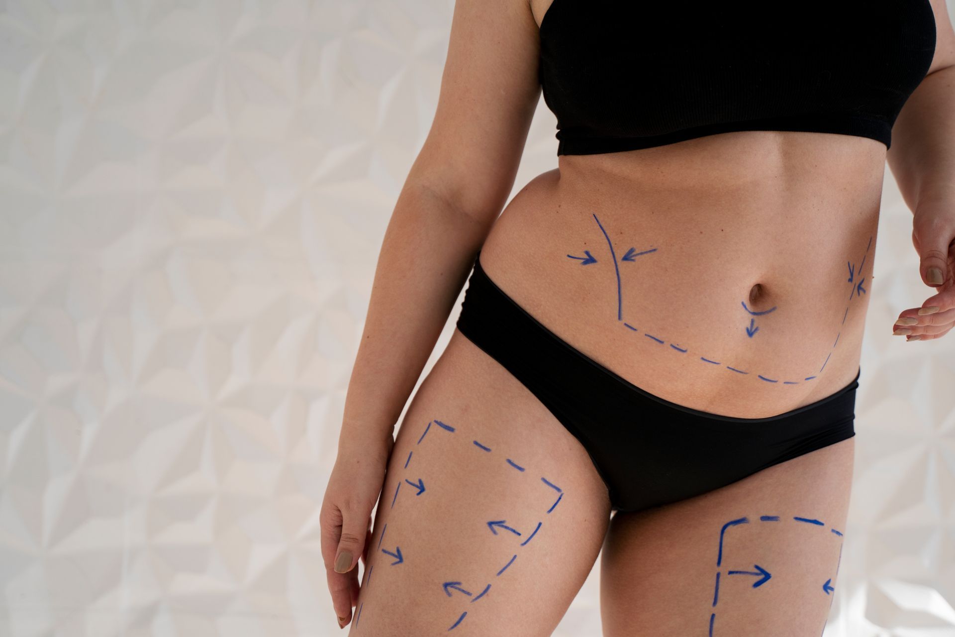 A woman in black underwear has lines drawn on her stomach and thighs.