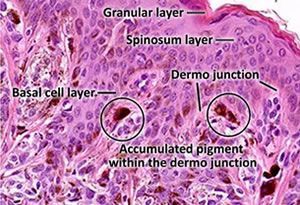 A microscope image of a dermo junction showing the granular layer spinosum layer basal cell layer and accumulated pigment