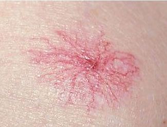 A close up of a red spot on a person 's skin.