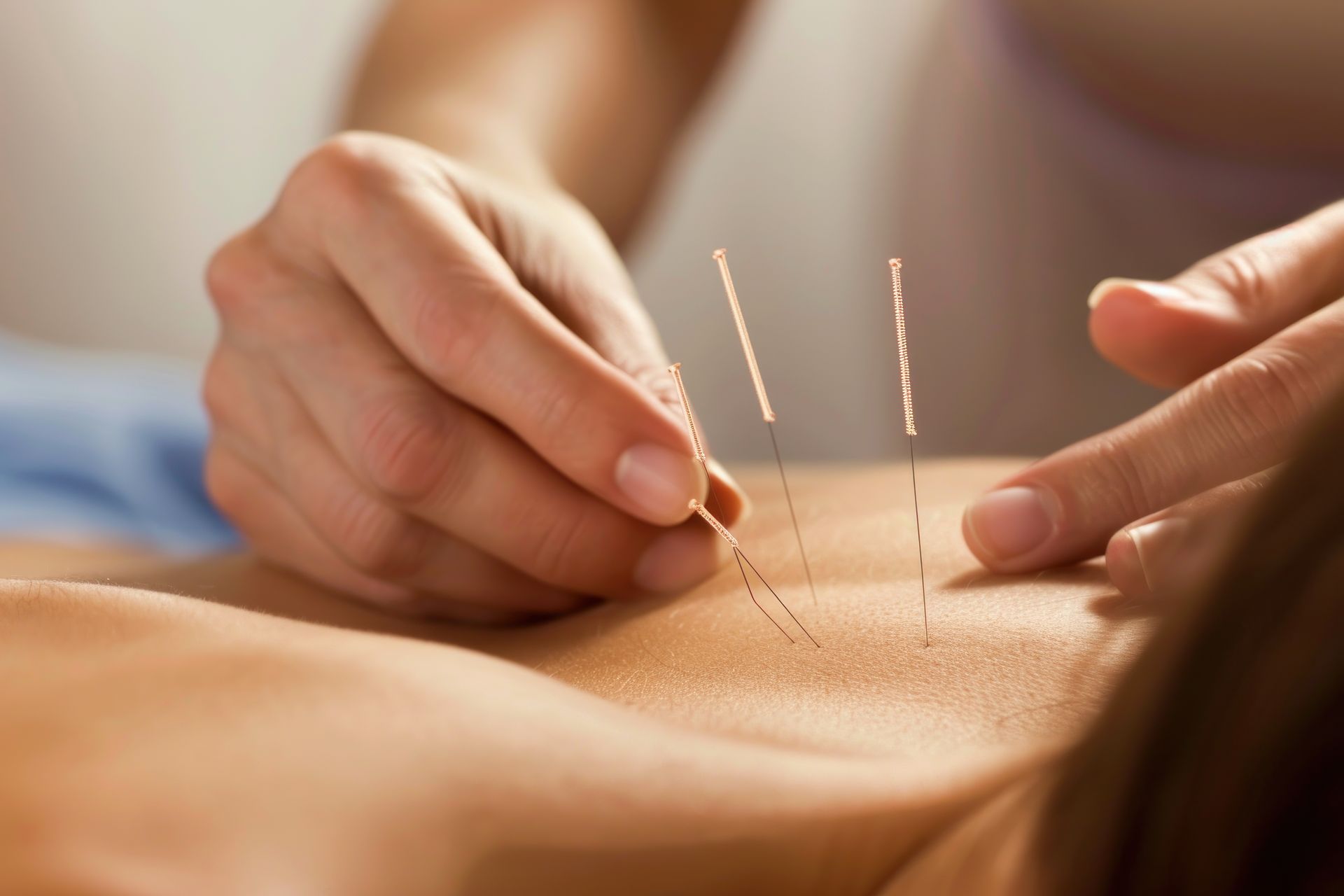 A person is getting acupuncture on their back.