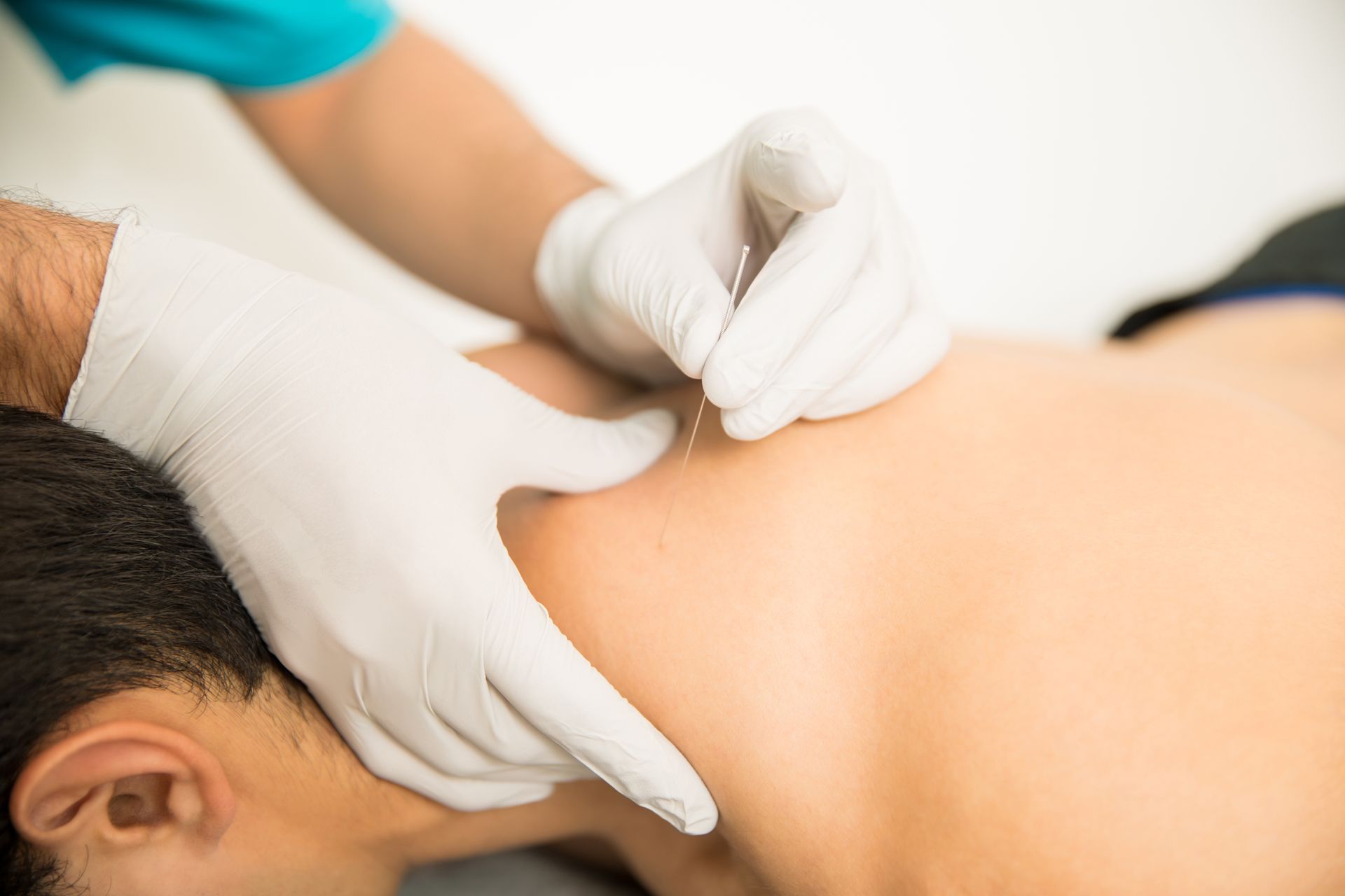 A person is getting an acupuncture treatment on their back.