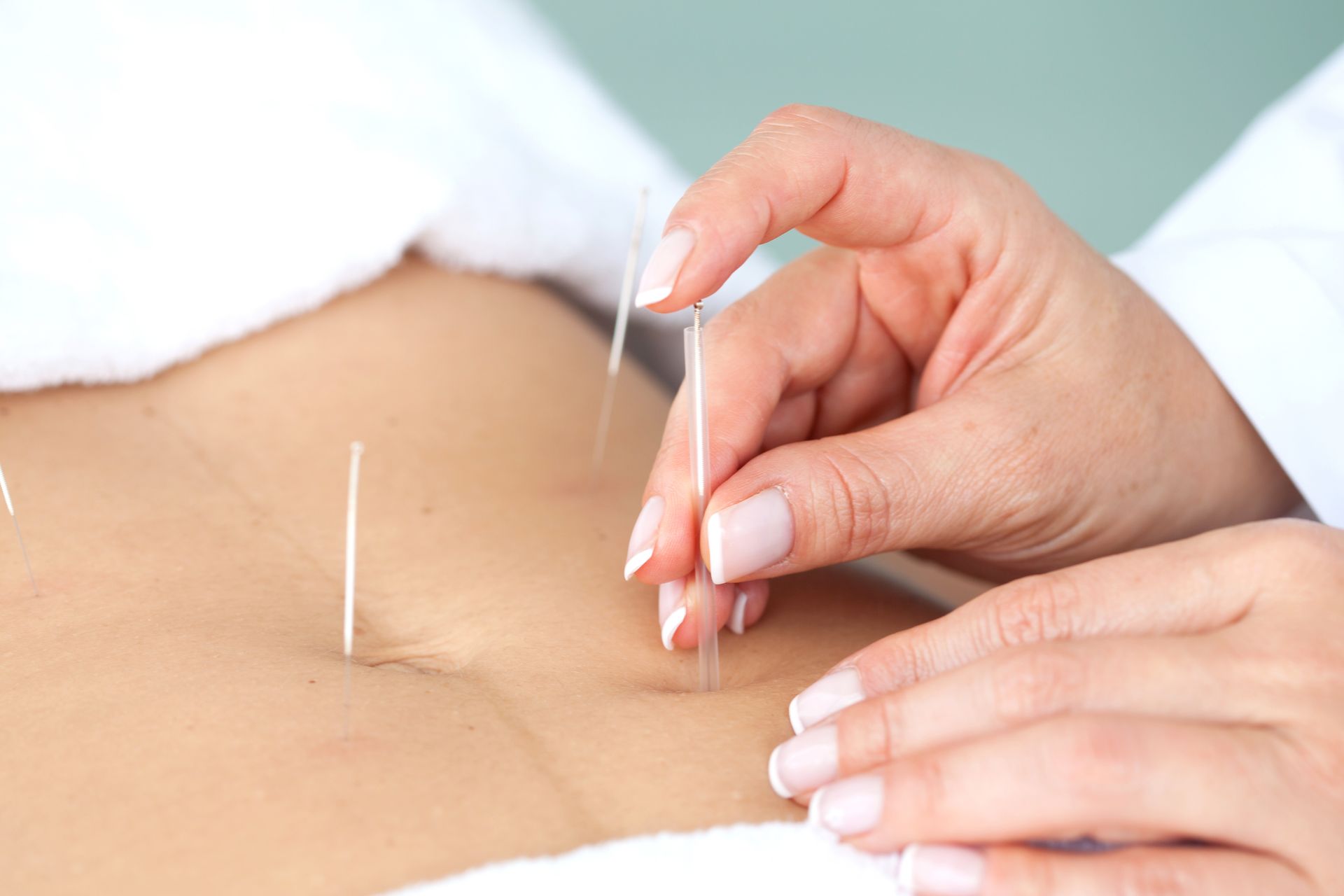 A woman is getting acupuncture on her stomach.