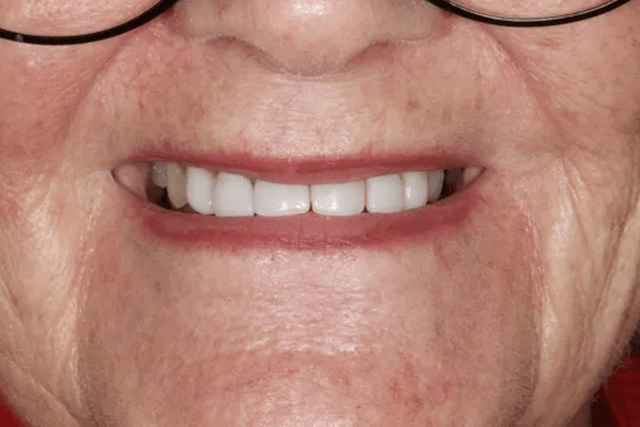 Before Senior Woman Teeth — Menai, NSW — Top Care Dental