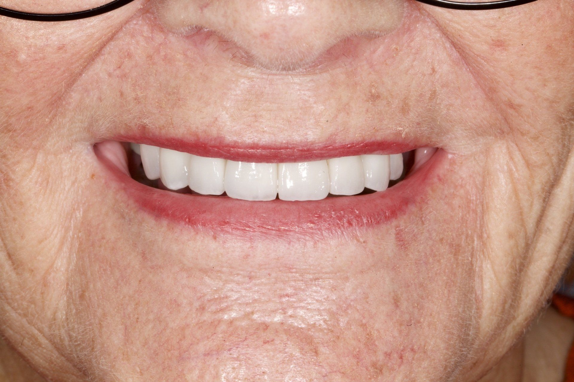 After Senior Woman Teeth — Menai, NSW — Top Care Dental